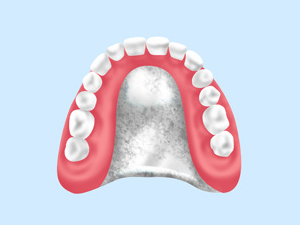 金属床入れ歯（チタン・コバルトクロム）