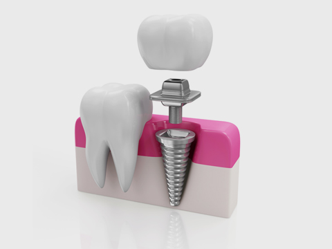 インプラント治療とは