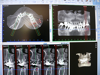 取り組み　その1歯科用CTを用いた精密な診断