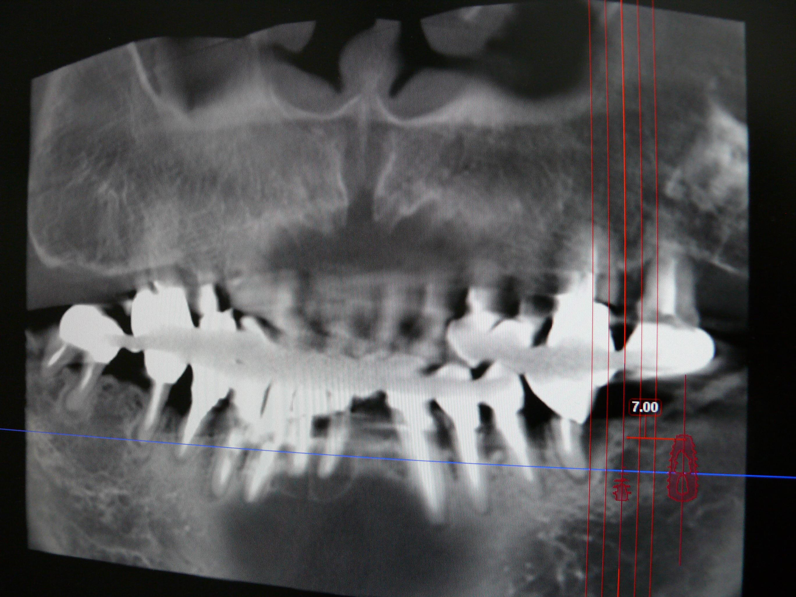 取り組み　その1歯科用CTを用いた精密な診断