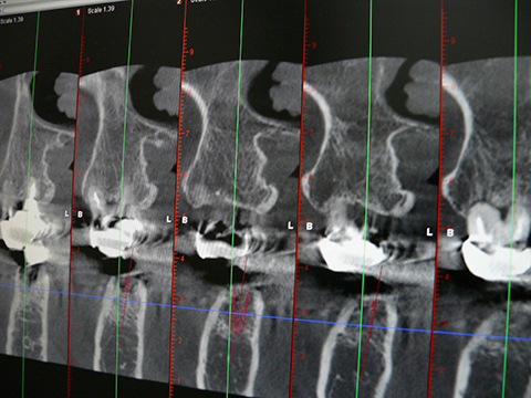 取り組み　その1歯科用CTを用いた精密な診断