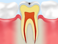 CO：ごく初期の虫歯