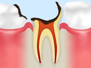 C3：神経に達した虫歯