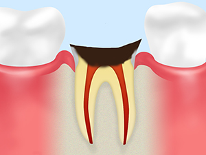 C4：歯根に達した虫歯