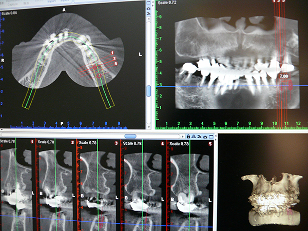 ～深い虫歯も歯科用CTで的確な根管治療を～