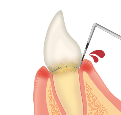 歯周病精密検査