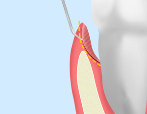 歯周ポケットそうは術